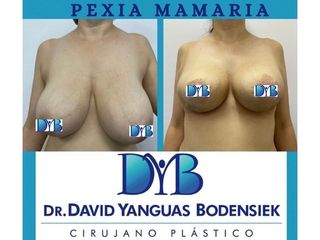 Mamoplastia de reducción - Dr. David Yanguas Bodensiek