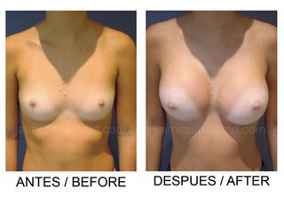 Mamoplastia de aumento