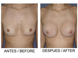 Mamoplastia de aumento