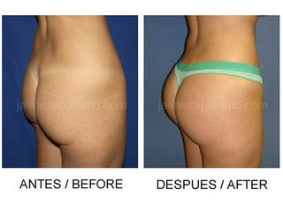 Gluteoplastia