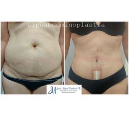 Lipoabdominoplastia