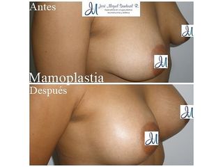 Mastoplastica additiva - Dr. José Miguel Sandoval Rodríguez