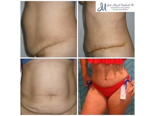 Abdominoplastia - Dr. José Miguel Sandoval Rodríguez