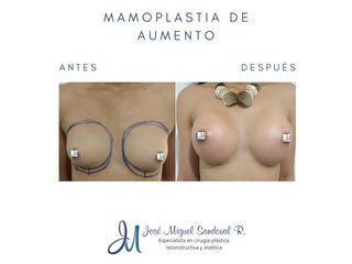 Mamoplastia de aumento - Dr. José Miguel Sandoval Rodríguez
