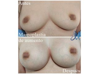 Mamoplastia de aumento - Dr. José Miguel Sandoval Rodríguez