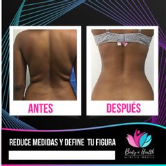 Body N´Health - Liposucción