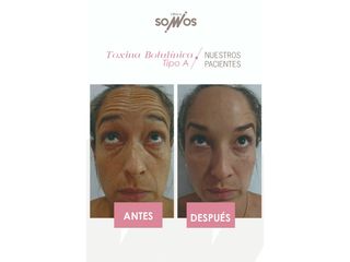 Botox Antes y después - Clinica Somos