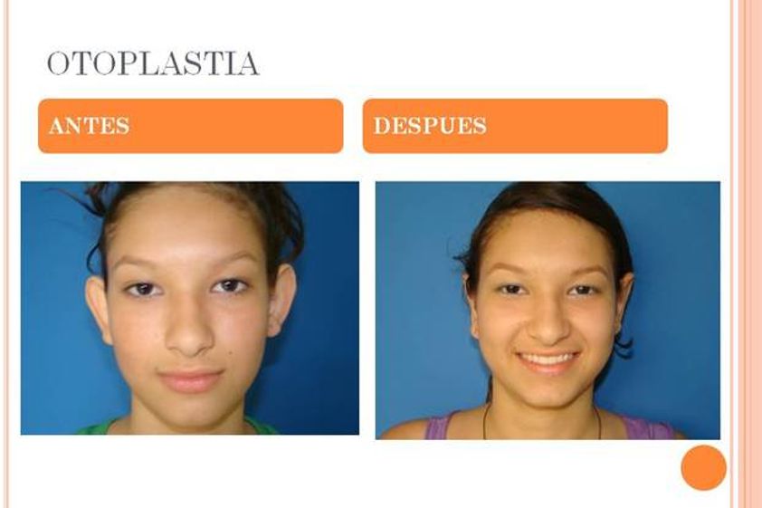 Otoplastia antes y después - 524474