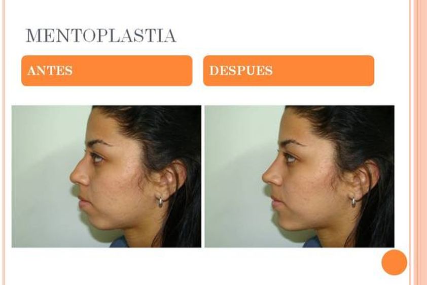 Mentoplastia antes y después - 524475