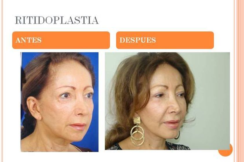 Rejuvenecimiento facial antes y después - 524477