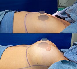 Mamoplastia de aumento - Dra. Nicole Echeverry