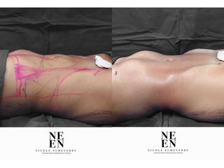 Liposucción - Dra. Nicole Echeverry