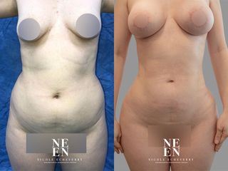 Lipoescultura - Dra. Nicole Echeverry