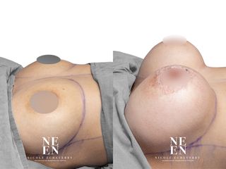 Mamoplastia de aumento - Dra. Nicole Echeverry
