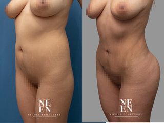 Lipoescultura - Dra. Nicole Echeverry