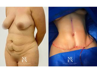 Abdominoplastia - Dra. Nicole Echeverry