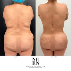 Liposucción - Dra. Nicole Echeverry