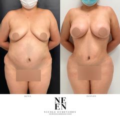 Liposucción - Dra. Nicole Echeverry