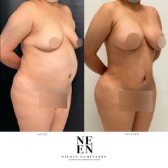 Liposucción - Dra. Nicole Echeverry