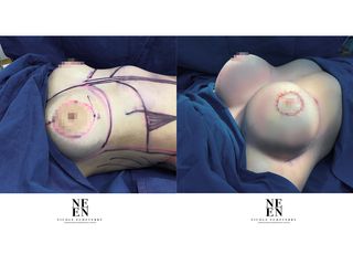 Mamoplastia de aumento - Dra. Nicole Echeverry