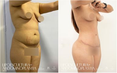 Lipoescultura - Dra. Nicole Echeverry
