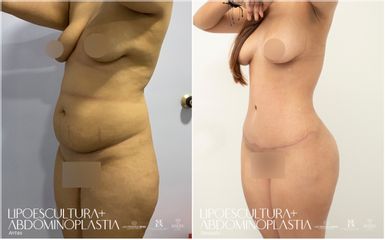 Lipoescultura - Dra. Nicole Echeverry