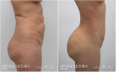 Lipoescultura - Dra. Nicole Echeverry
