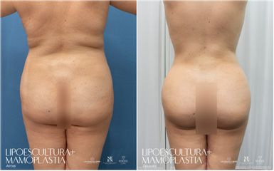 Lipoescultura - Dra. Nicole Echeverry