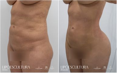 Lipoescultura - Dra. Nicole Echeverry