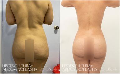 Lipoescultura - Dra. Nicole Echeverry