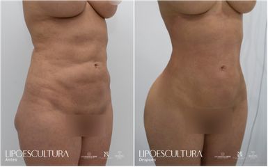 Lipoescultura - Dra. Nicole Echeverry