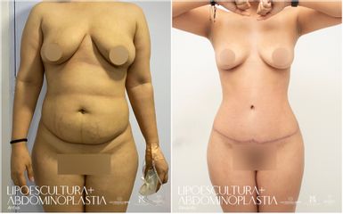 Abdominoplastia - Dra. Nicole Echeverry