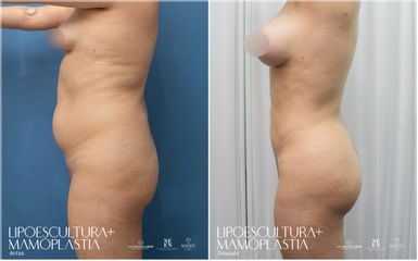 Lipoescultura - Dra. Nicole Echeverry