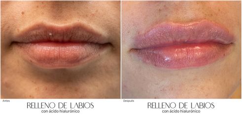 Aumento de labios - Dra. Nicole Echeverry