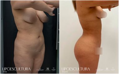 Lipoescultura - Dra. Nicole Echeverry
