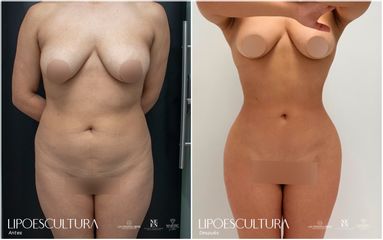 Lipoescultura - Dra. Nicole Echeverry