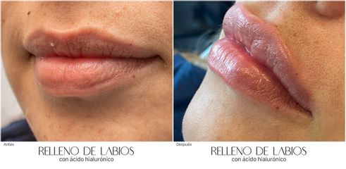 Aumento de labios - Dra. Nicole Echeverry