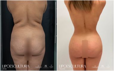 Lipoescultura - Dra. Nicole Echeverry