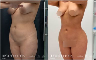 Lipoescultura - Dra. Nicole Echeverry