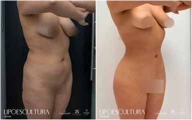 Lipoescultura - Dra. Nicole Echeverry