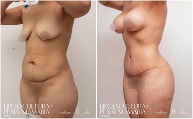 Lipoescultura - Dra. Nicole Echeverry