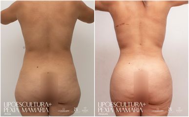Lipoescultura - Dra. Nicole Echeverry