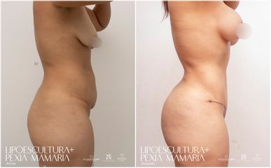 Lipoescultura - Dra. Nicole Echeverry