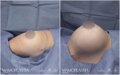 Mamoplastia de aumento - Dra. Nicole Echeverry