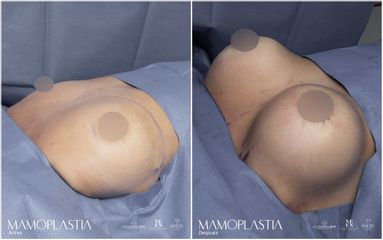 Mamoplastia de aumento - Dra. Nicole Echeverry
