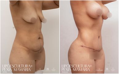 Lipoescultura - Dra. Nicole Echeverry