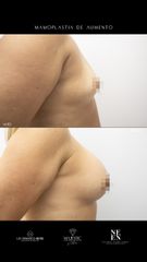 Mamoplastia de aumento - Dra. Nicole Echeverry