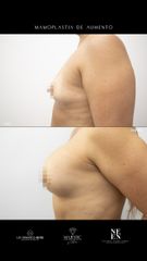 Mamoplastia de aumento - Dra. Nicole Echeverry