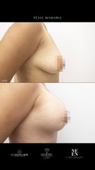 Mamoplastia de aumento - Dra. Nicole Echeverry