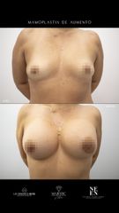 Mamoplastia de aumento - Dra. Nicole Echeverry